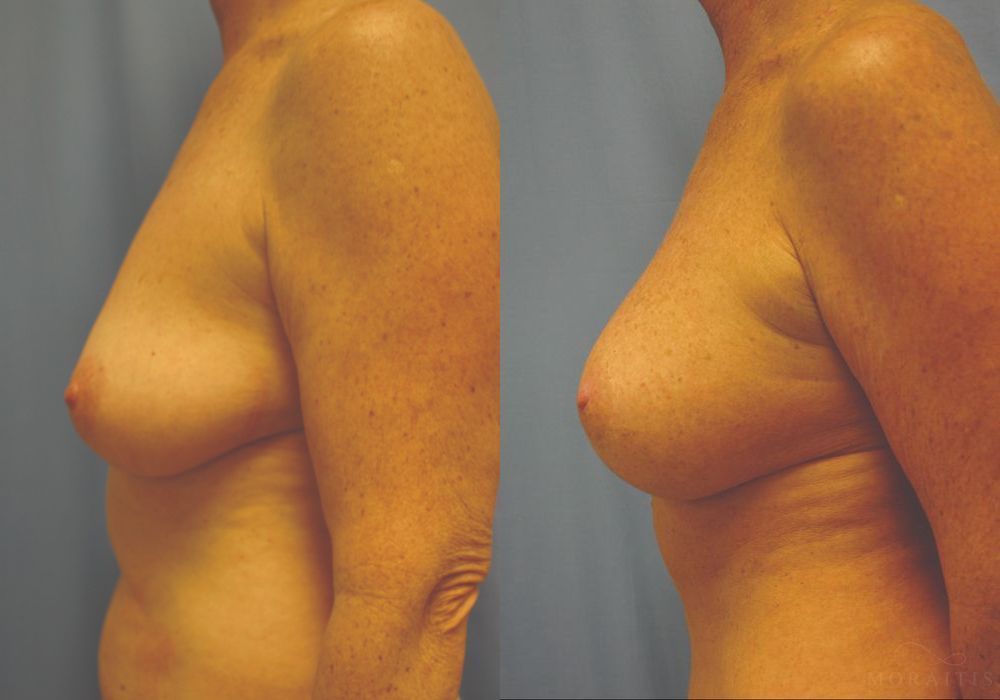 Breast Augmentation with Lift - Thumbnail 3