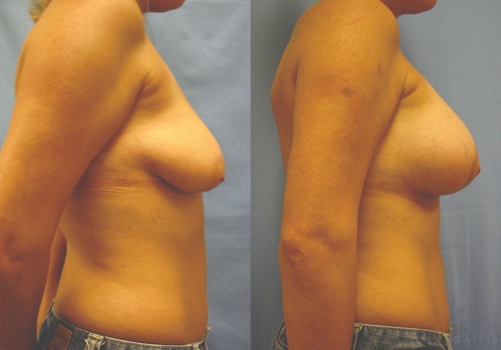Breast Augmentation with Lift - Thumbnail 3