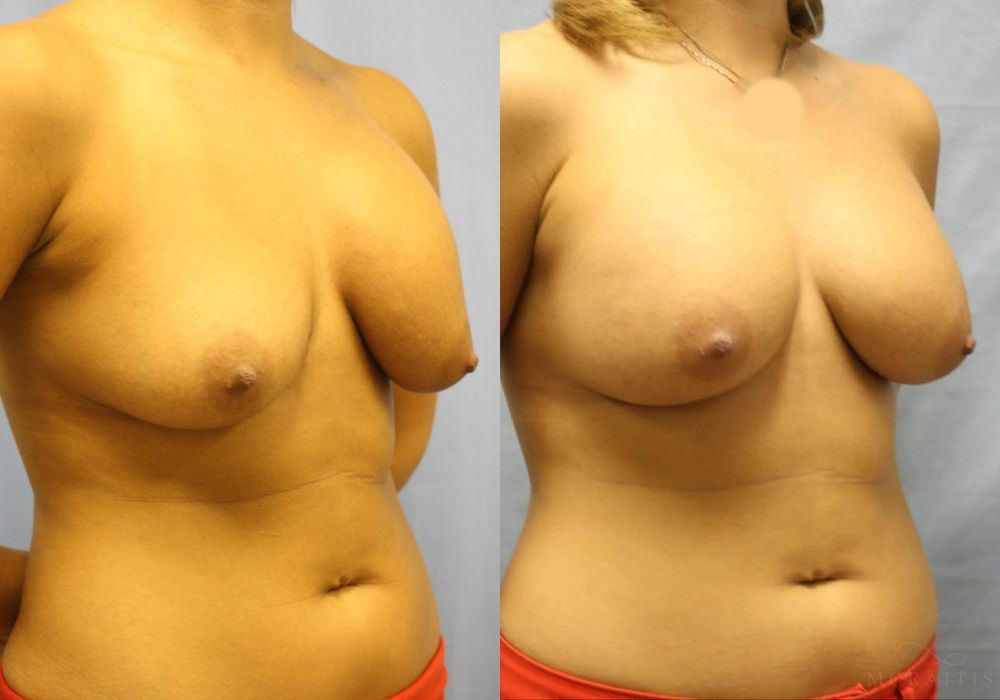 Breast Implant Exchange - Thumbnail 2