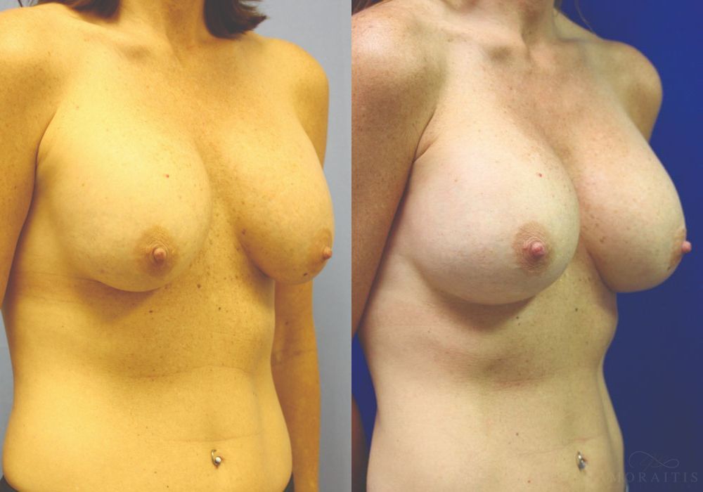 Breast Implant Exchange - Thumbnail 2