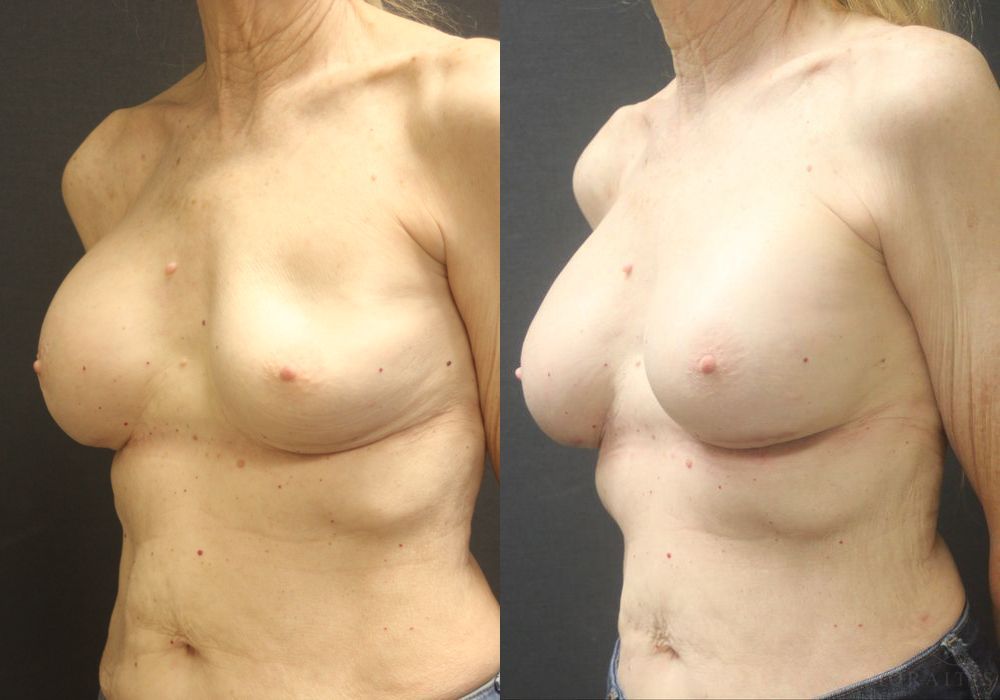 Breast Implant Exchange - Thumbnail 2