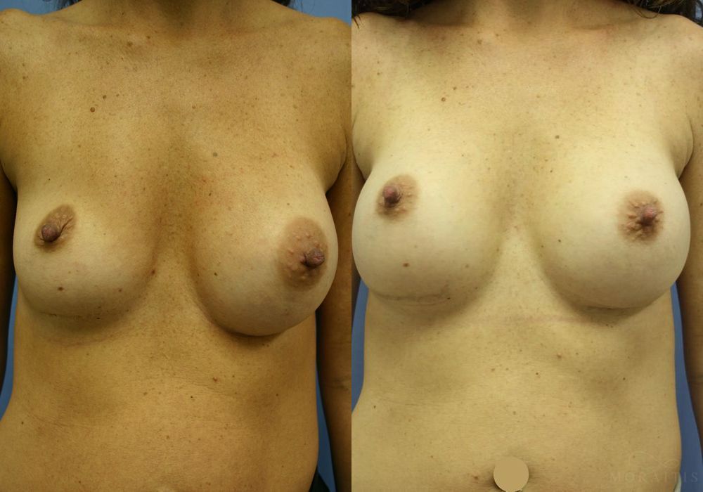 Breast Implant Exchange - Case 15424