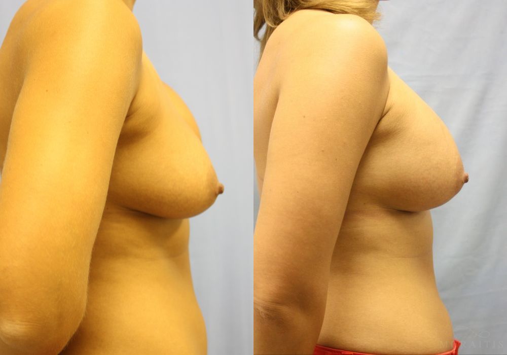 Breast Implant Exchange - Thumbnail 3