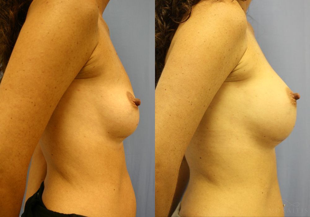 Breast Implant Exchange - Thumbnail 3