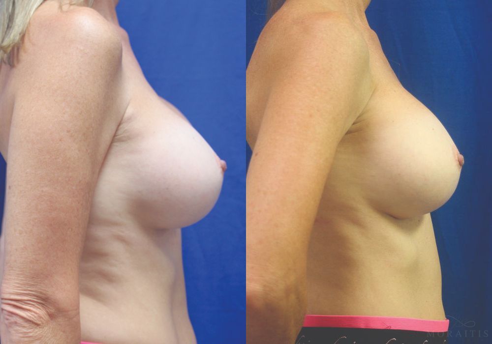 Breast Implant Exchange - Thumbnail 3