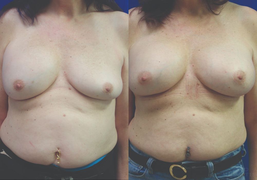 Breast Implant Exchange - Case 15426