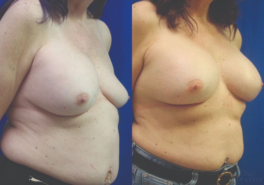 Breast Implant Exchange - Thumbnail 2