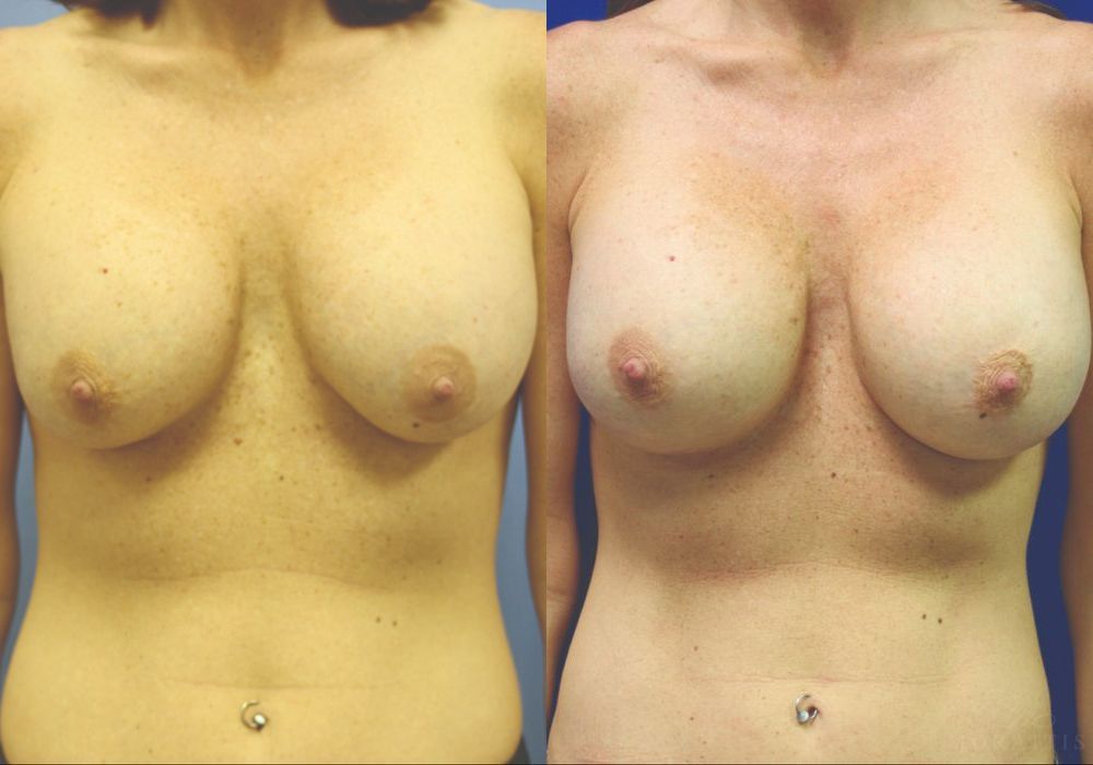 Breast Implant Exchange - Case 15425