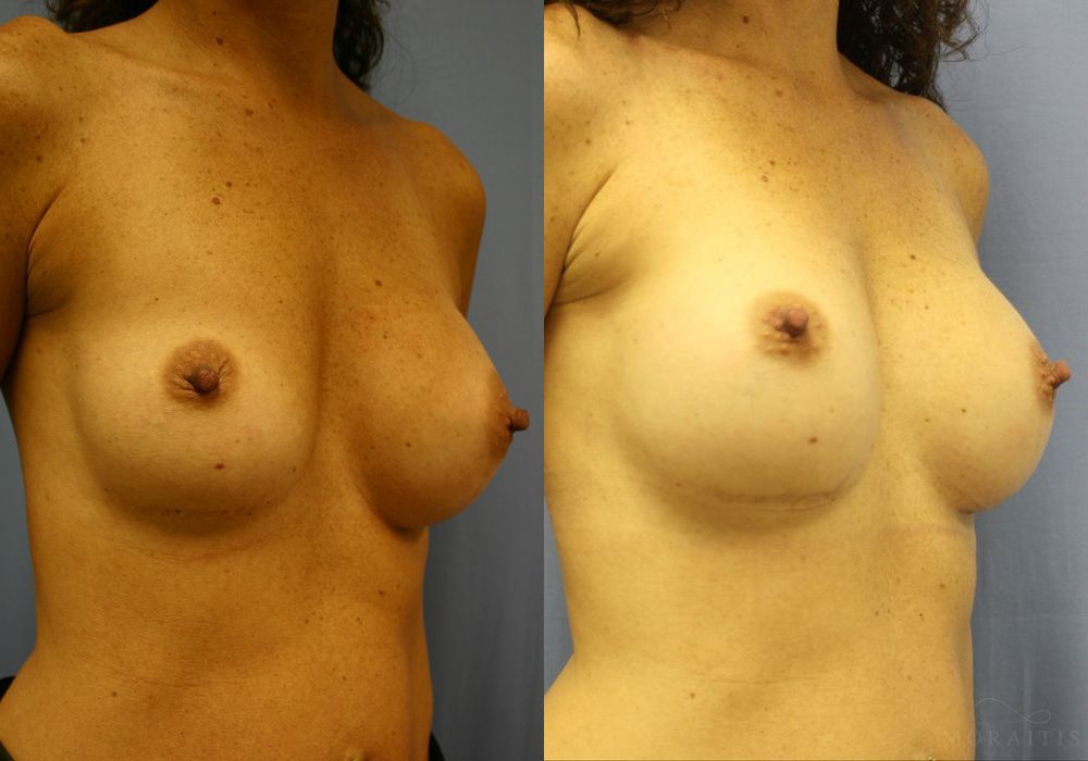 Breast Implant Exchange - Thumbnail 2
