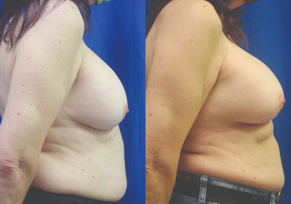 Breast Implant Exchange - Thumbnail 3