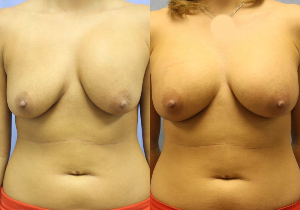 Breast Implant Exchange - Case 15429