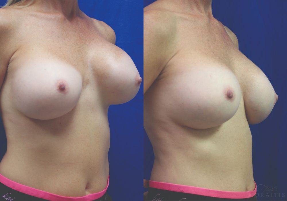 Breast Implant Exchange - Thumbnail 2