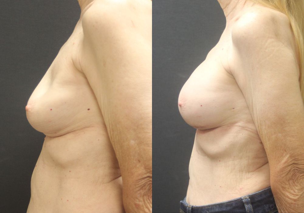 Breast Implant Exchange - Thumbnail 3
