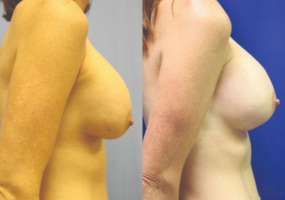 Breast Implant Exchange - Thumbnail 3