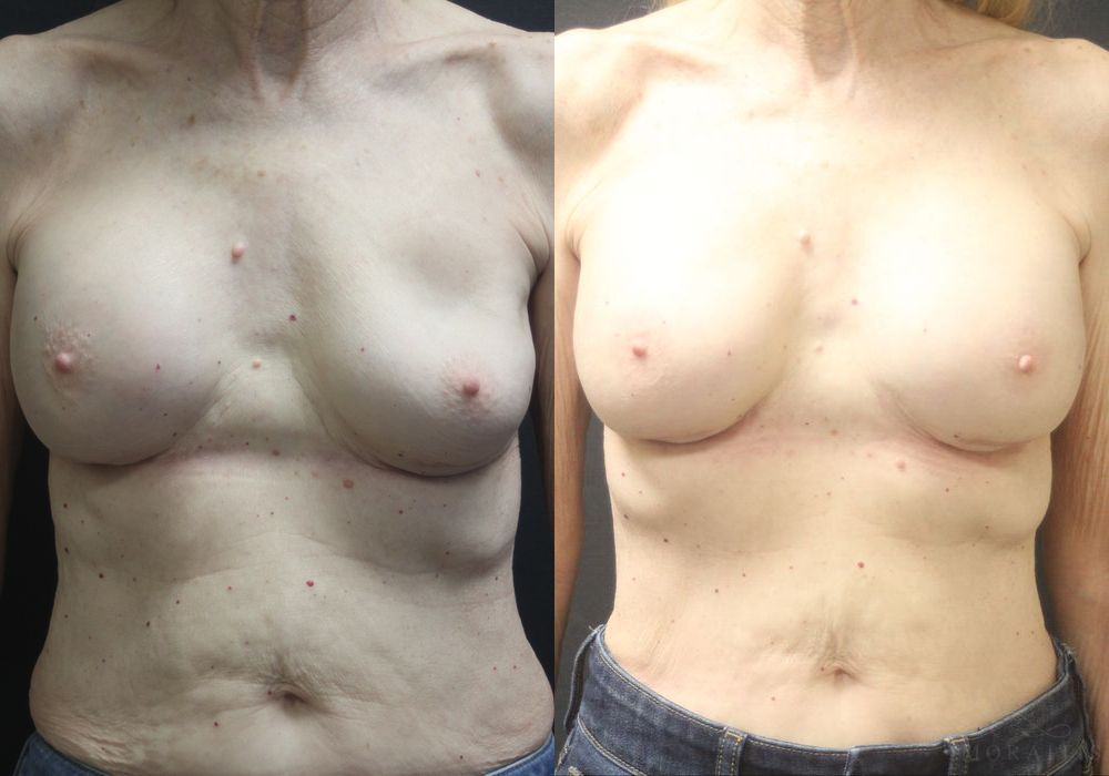 Breast Implant Exchange - Case 15523