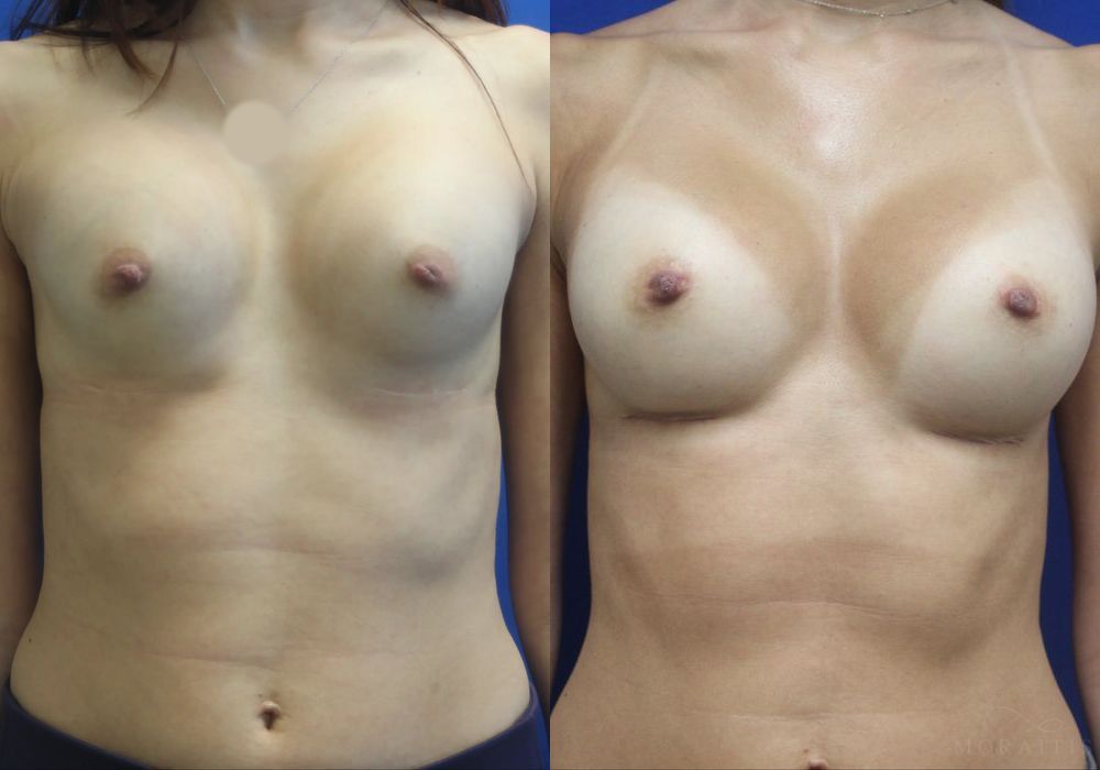 Breast Implant Exchange - Case 15428