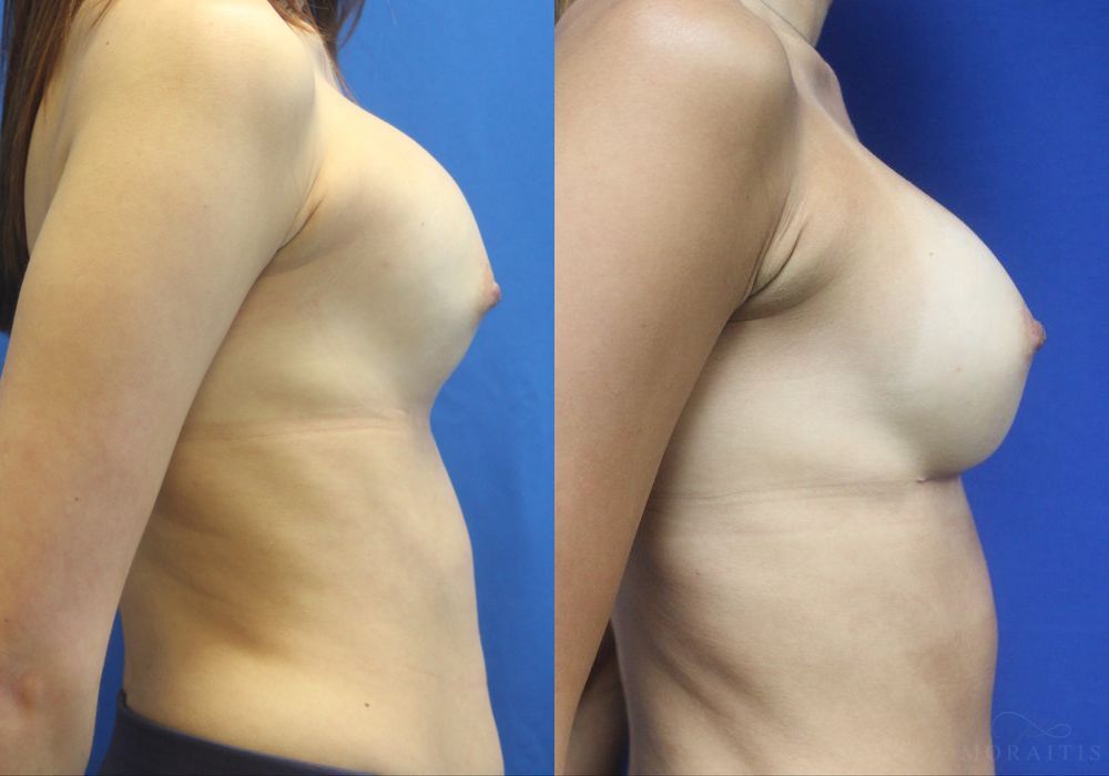 Breast Implant Exchange - Thumbnail 3