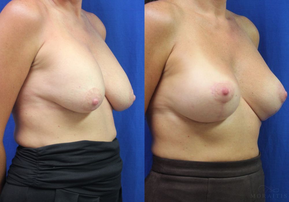 Breast Implant Exchange with Lift - Thumbnail 2