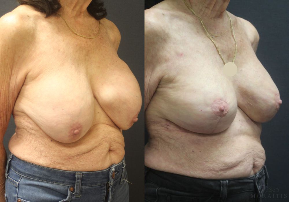 Breast Implant Exchange with Lift - Thumbnail 2