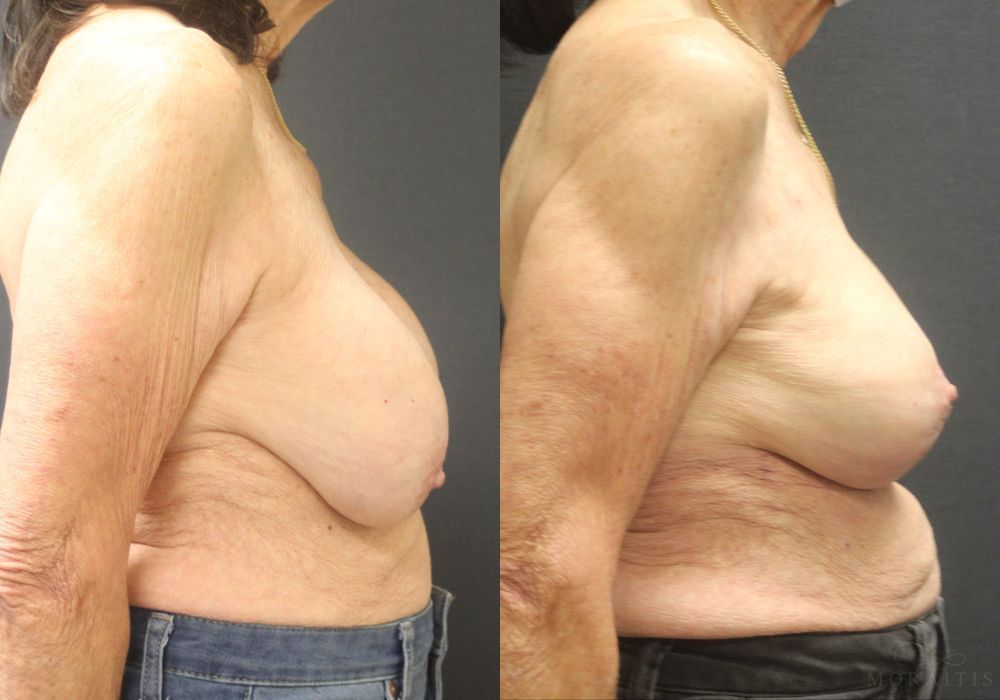 Breast Implant Exchange with Lift - Thumbnail 3
