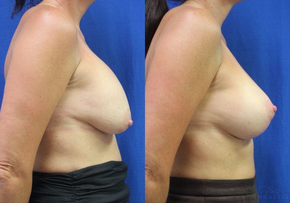 Breast Implant Exchange with Lift - Thumbnail 3