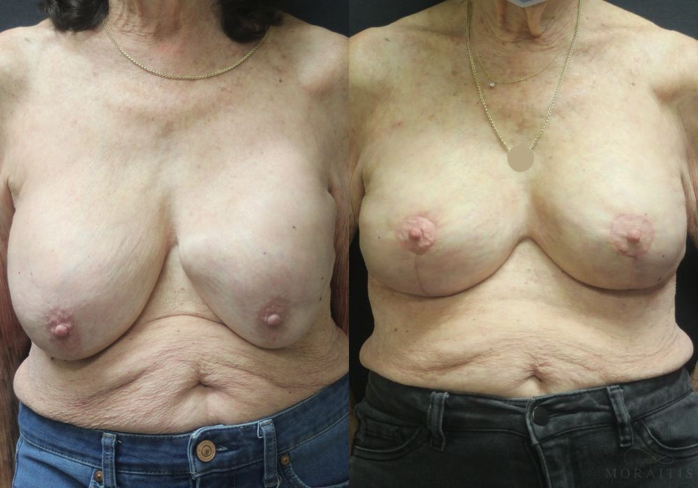 Breast Implant Exchange with Lift - Case 15431