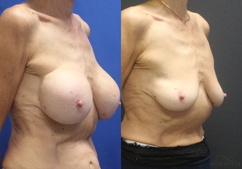 Breast Implant Removal - Thumbnail 2