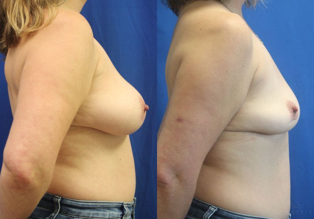 Breast Implant Removal - Thumbnail 3
