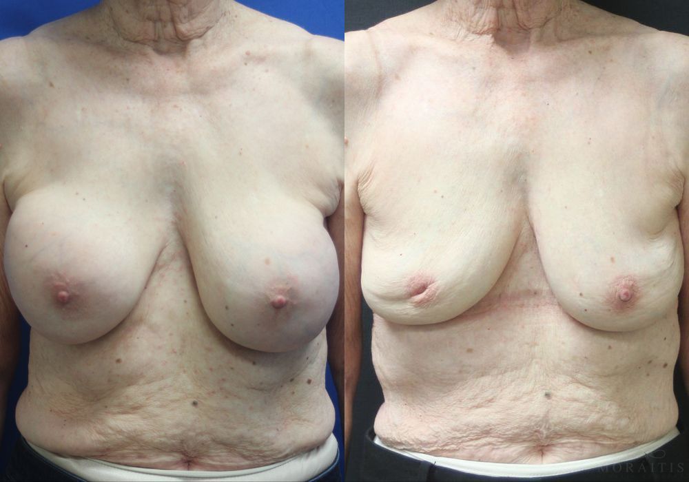 Breast Implant Removal - Case 15436