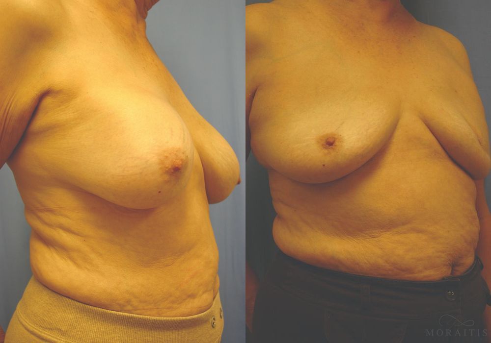 Breast Implant Removal - Thumbnail 2