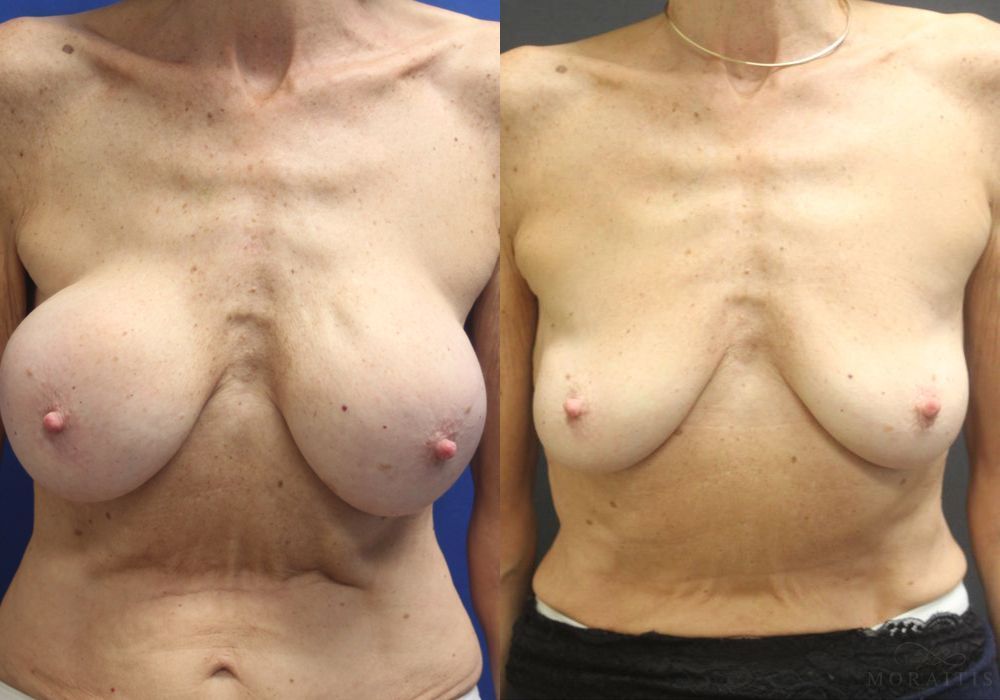 Breast Implant Removal - Case 15524