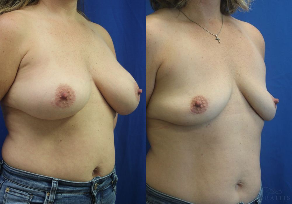 Breast Implant Removal - Thumbnail 2