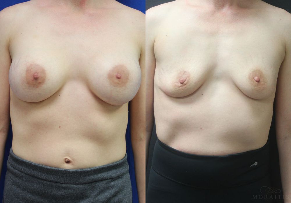 Breast Implant Removal - Case 15435