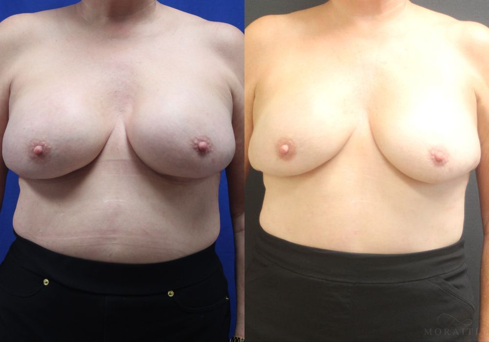Breast Implant Removal - Case 15525