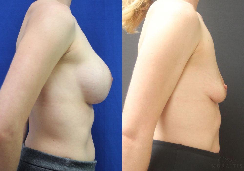 Breast Implant Removal - Thumbnail 3