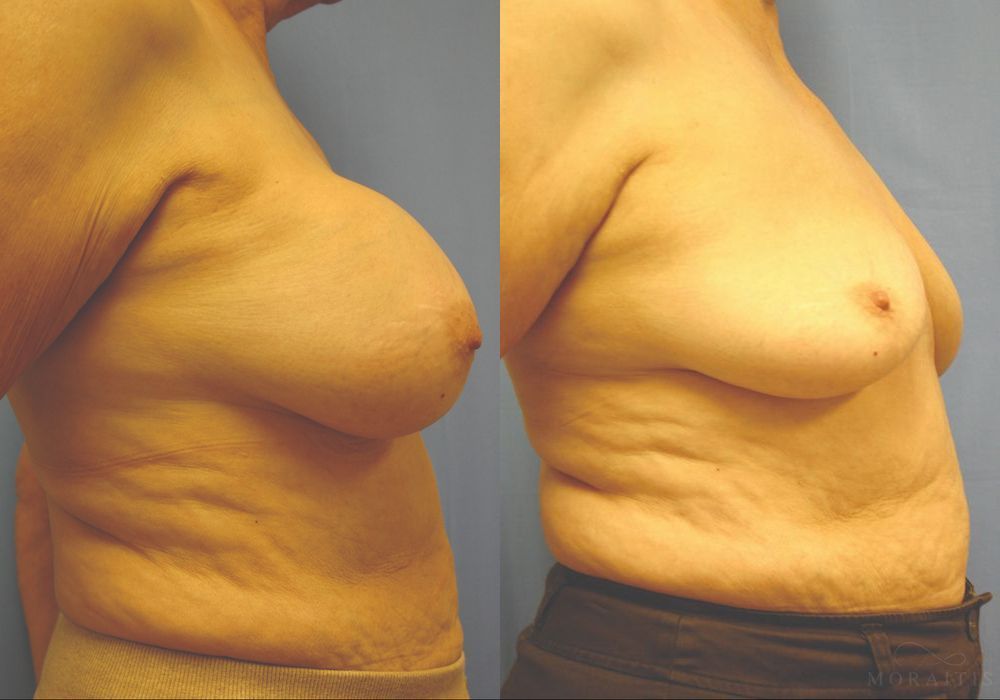 Breast Implant Removal - Thumbnail 3