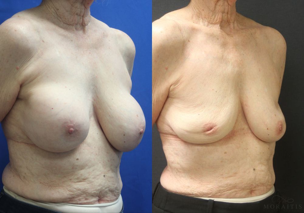 Breast Implant Removal - Thumbnail 2