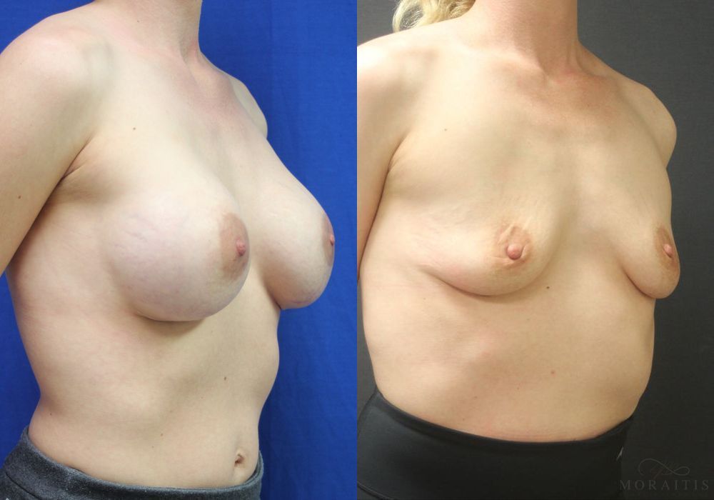Breast Implant Removal - Thumbnail 2