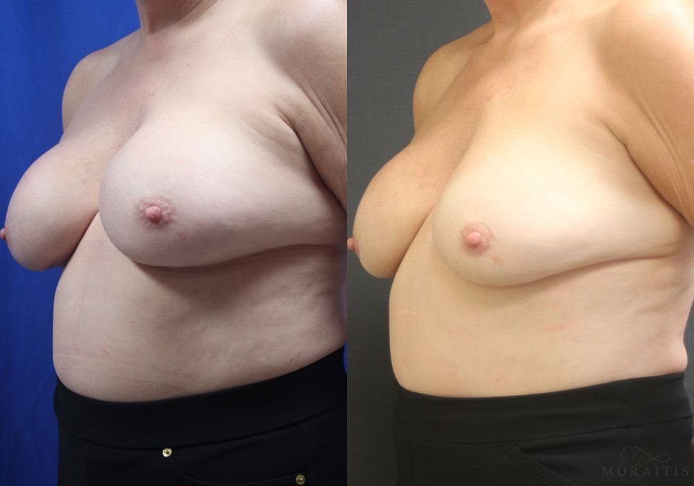 Breast Implant Removal - Thumbnail 2