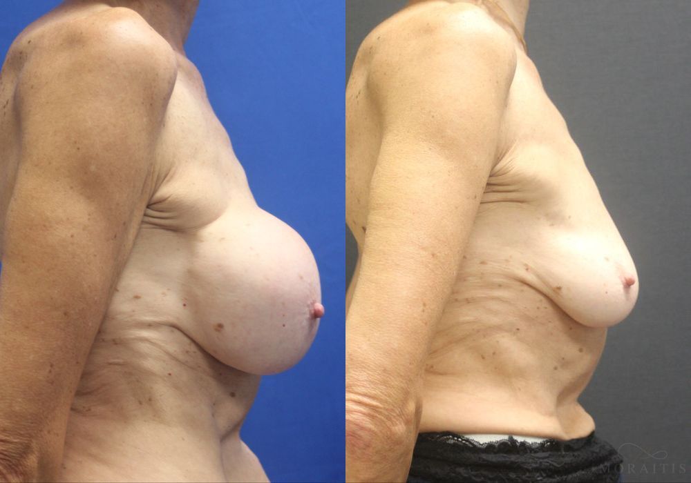 Breast Implant Removal - Thumbnail 3