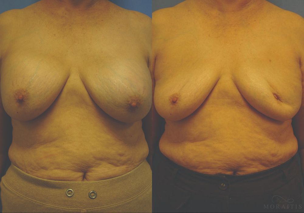Breast Implant Removal - Case 15432