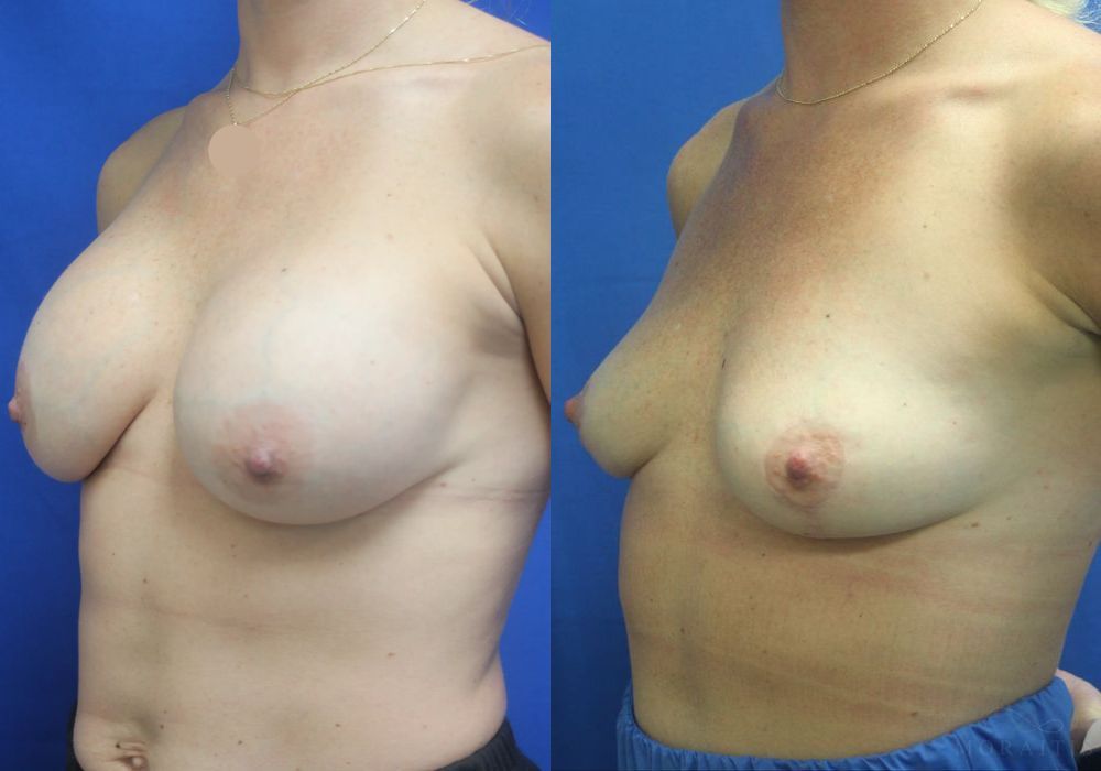 Breast Implant Removal with Lift - Thumbnail 2