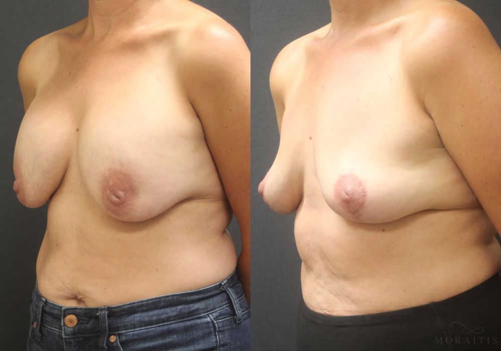 Breast Implant Removal with Lift - Thumbnail 2