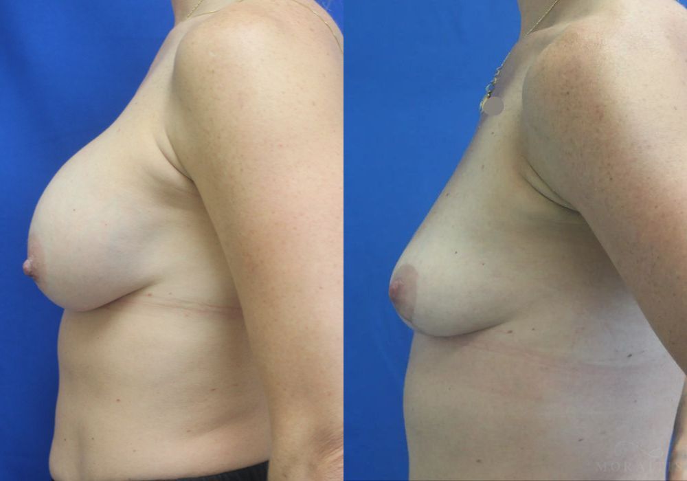 Breast Implant Removal with Lift - Case 15526
