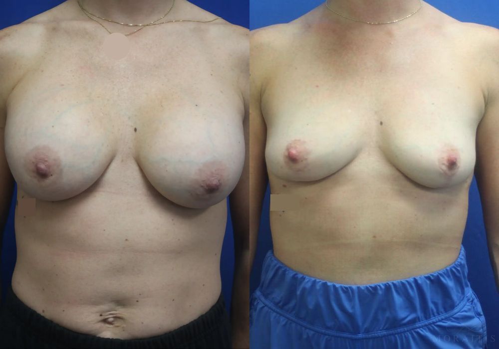 Breast Implant Removal with Lift - Case 15438