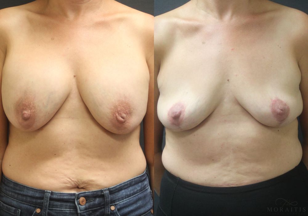 Breast Implant Removal with Lift - Case 15527