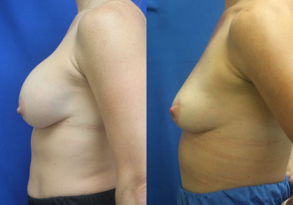 Breast Implant Removal with Lift - Thumbnail 3