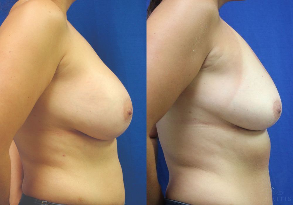 Breast Implant Removal with Lift - Thumbnail 3