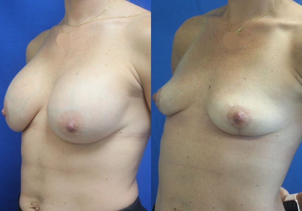 Breast Implant Removal with Lift - Thumbnail 3