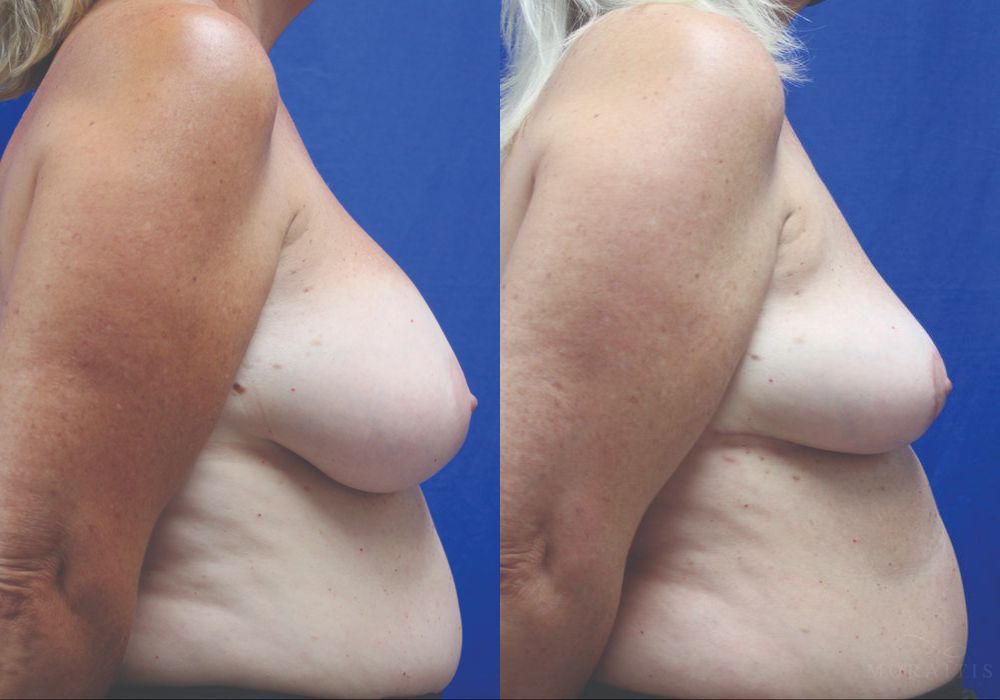 Breast Implant Removal - Thumbnail 3